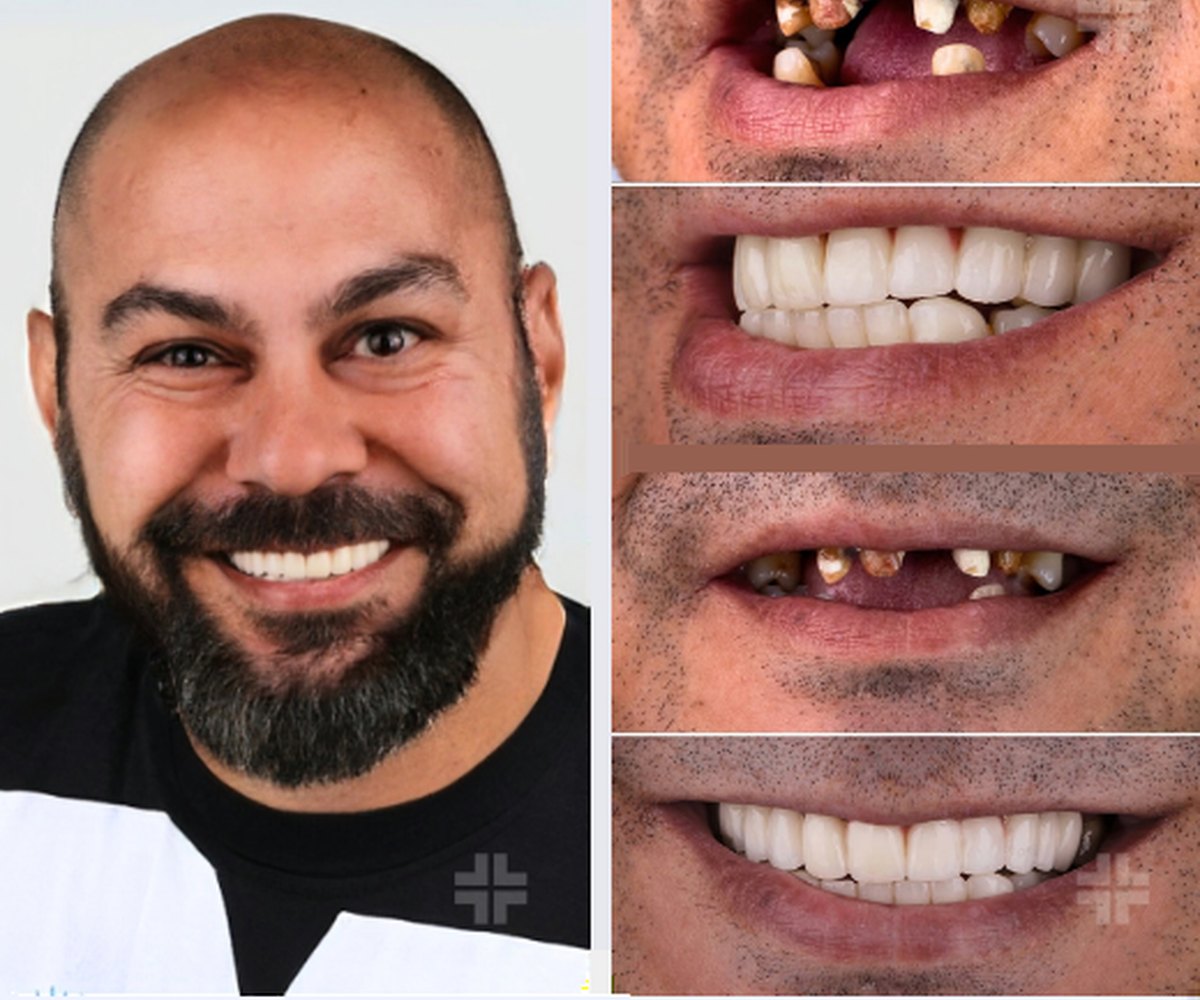 Implantes de arcada completa