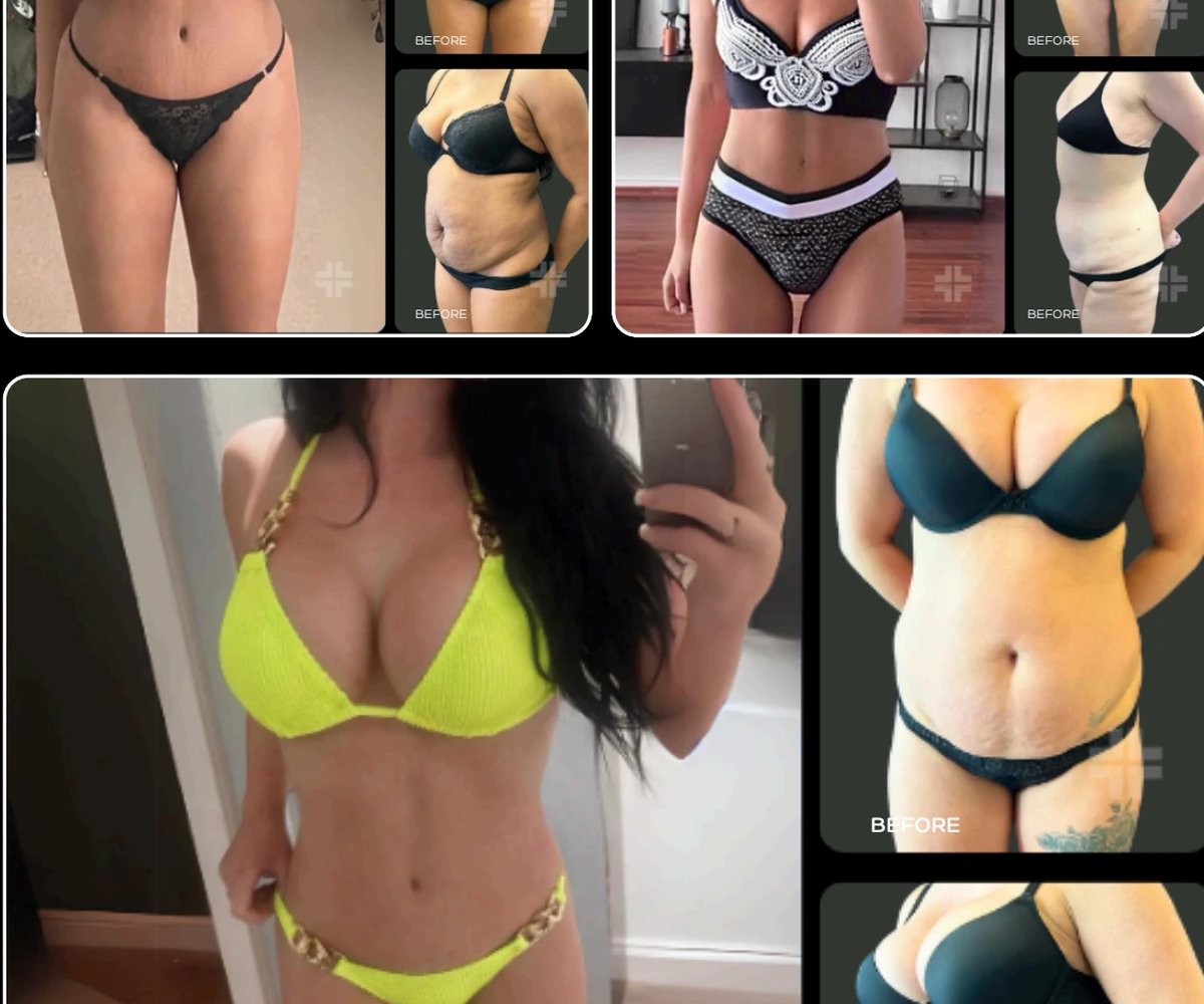 Tummy tuck