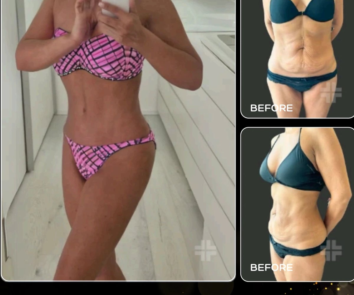 Tummy tuck