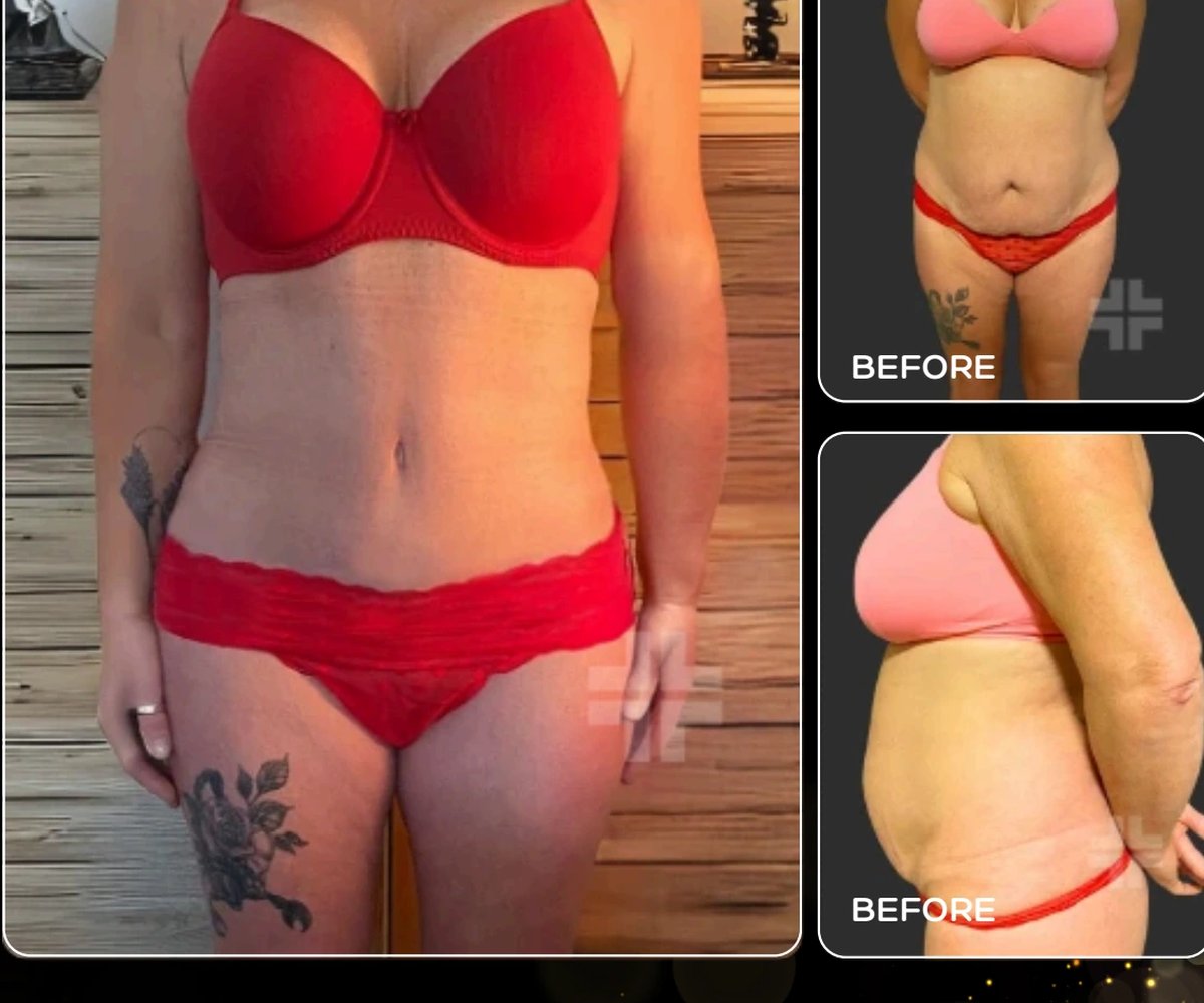 360 liposuction