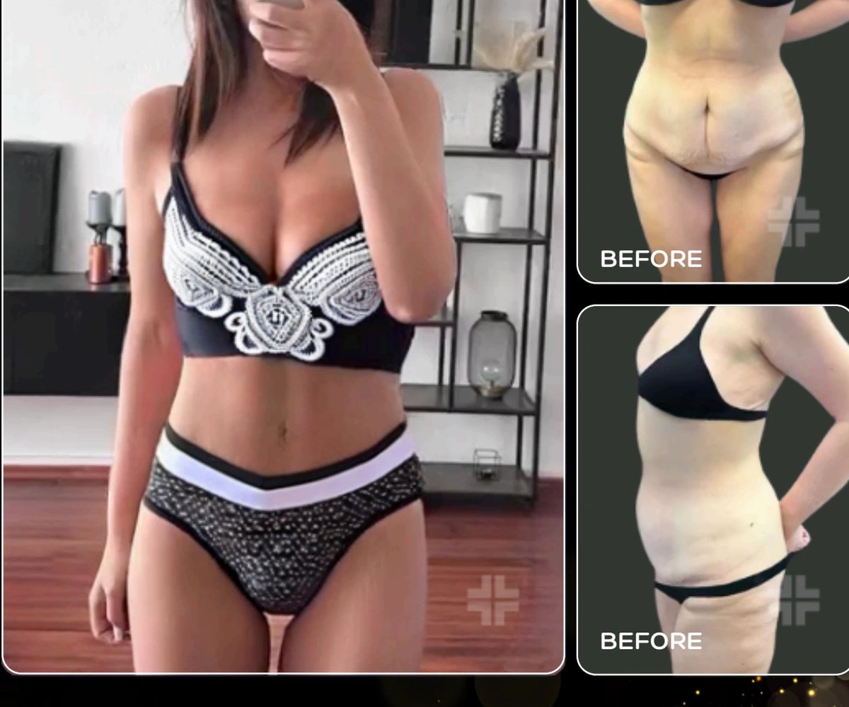 Tummy tuck