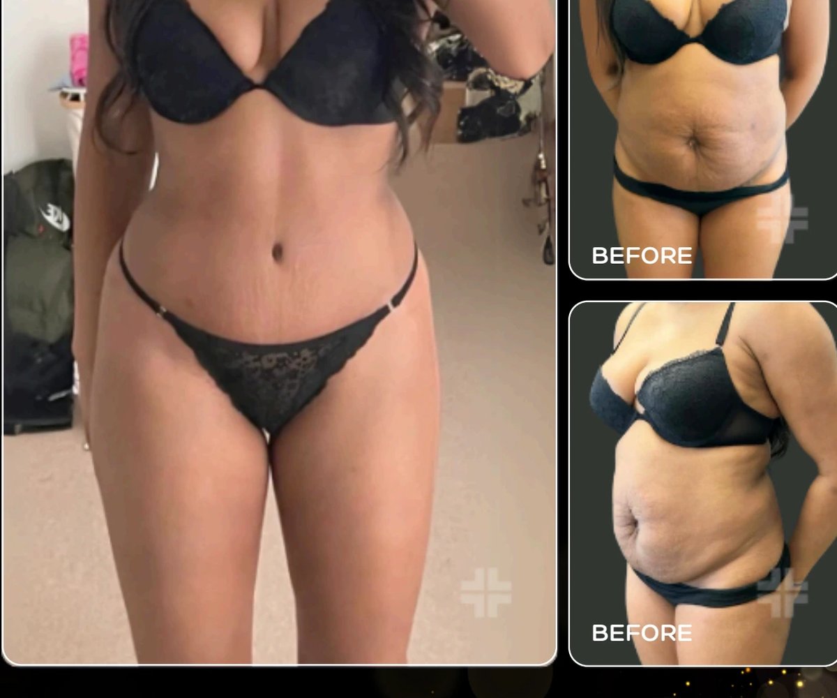 360 liposuction