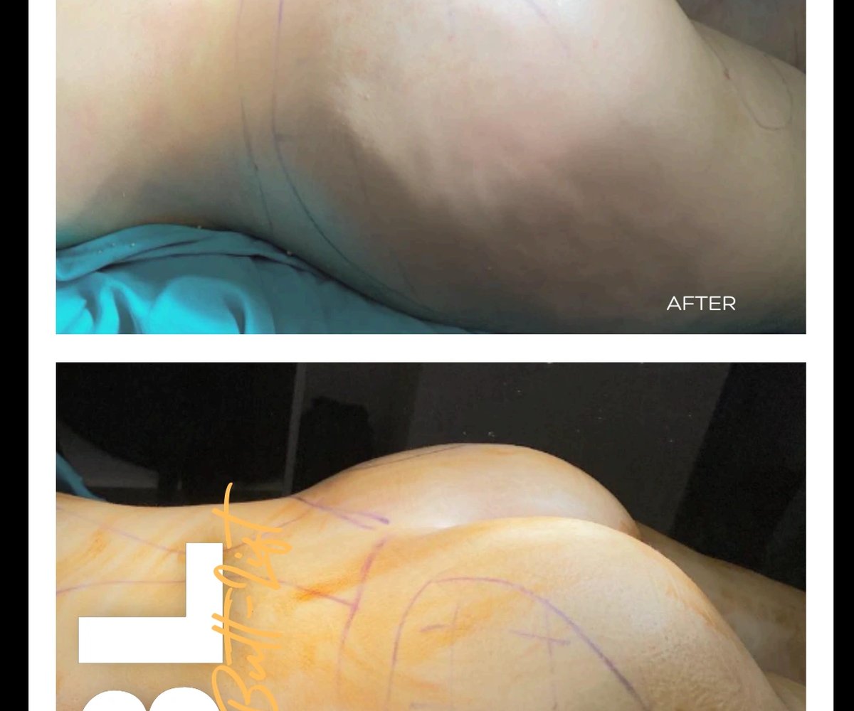Brazilian butt-lift