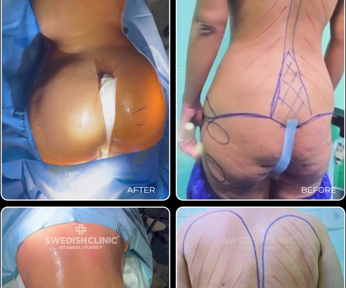 Brazilian butt-lift