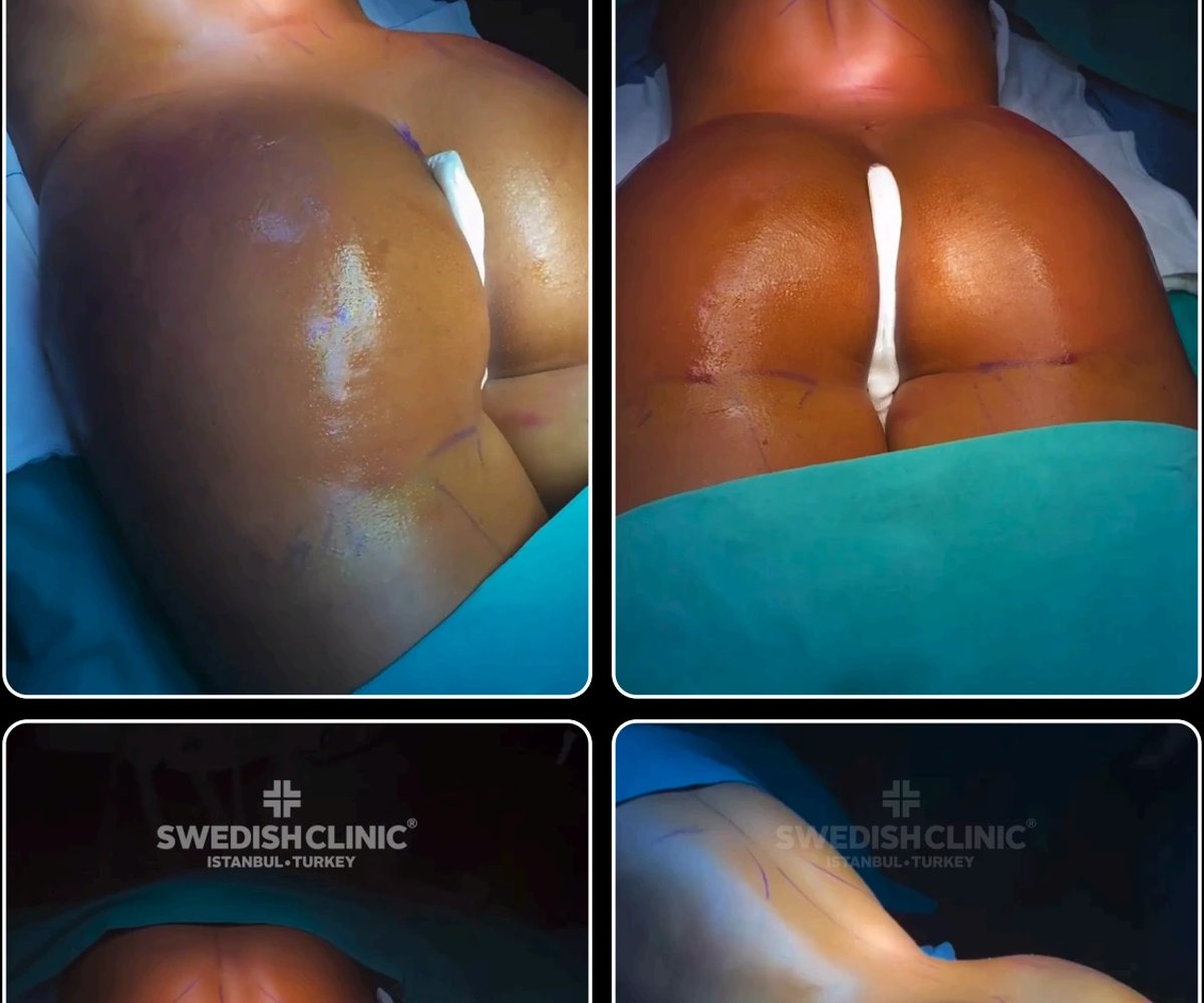 Brazilian butt-lift
