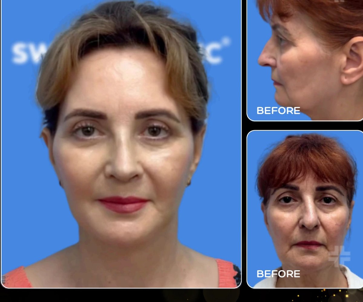Face lift