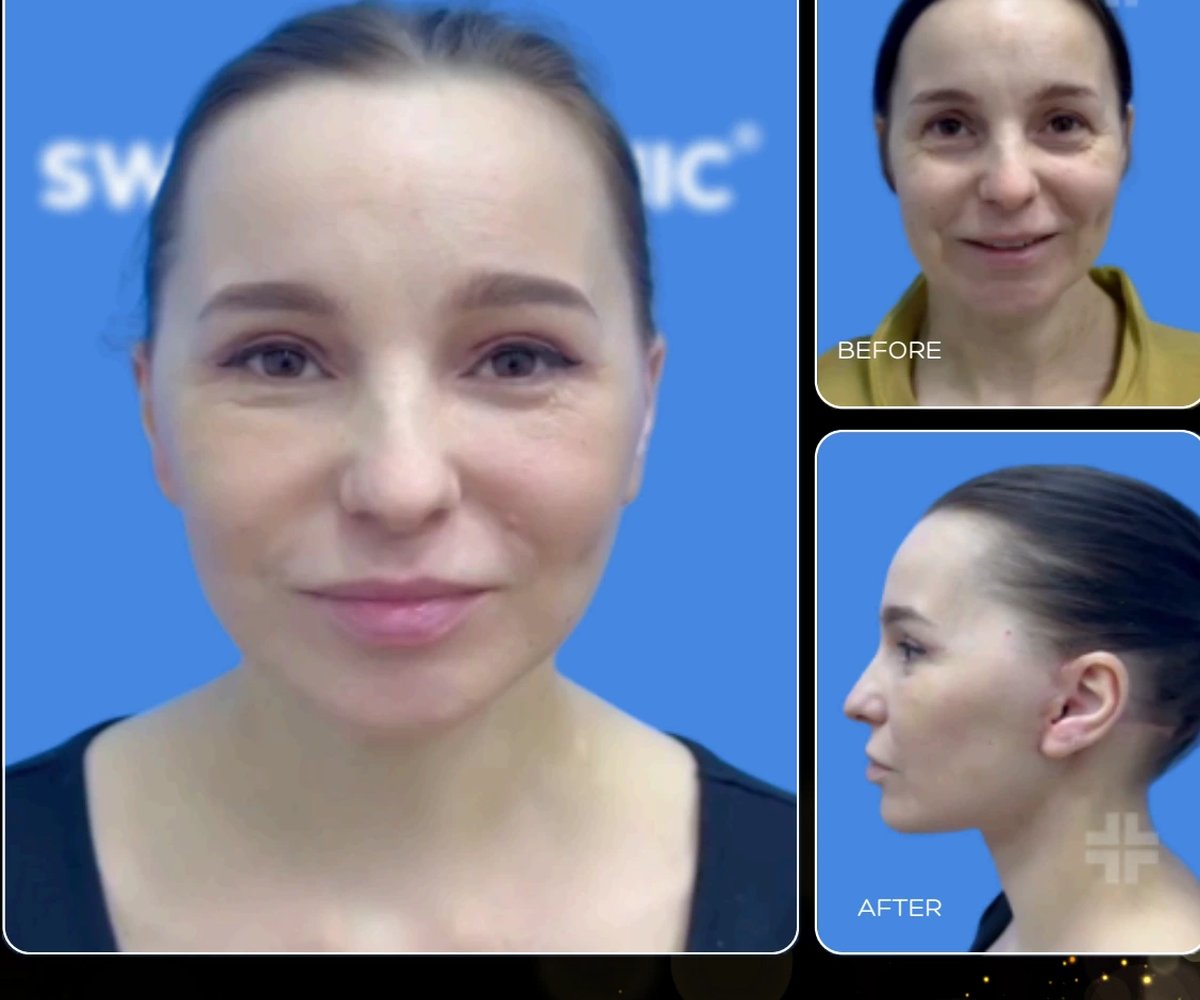 Face lift
