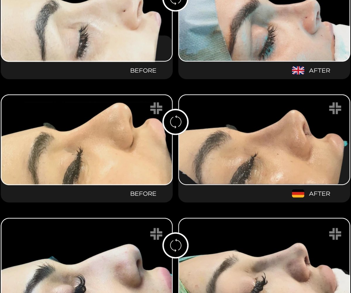 Rhinoplasty