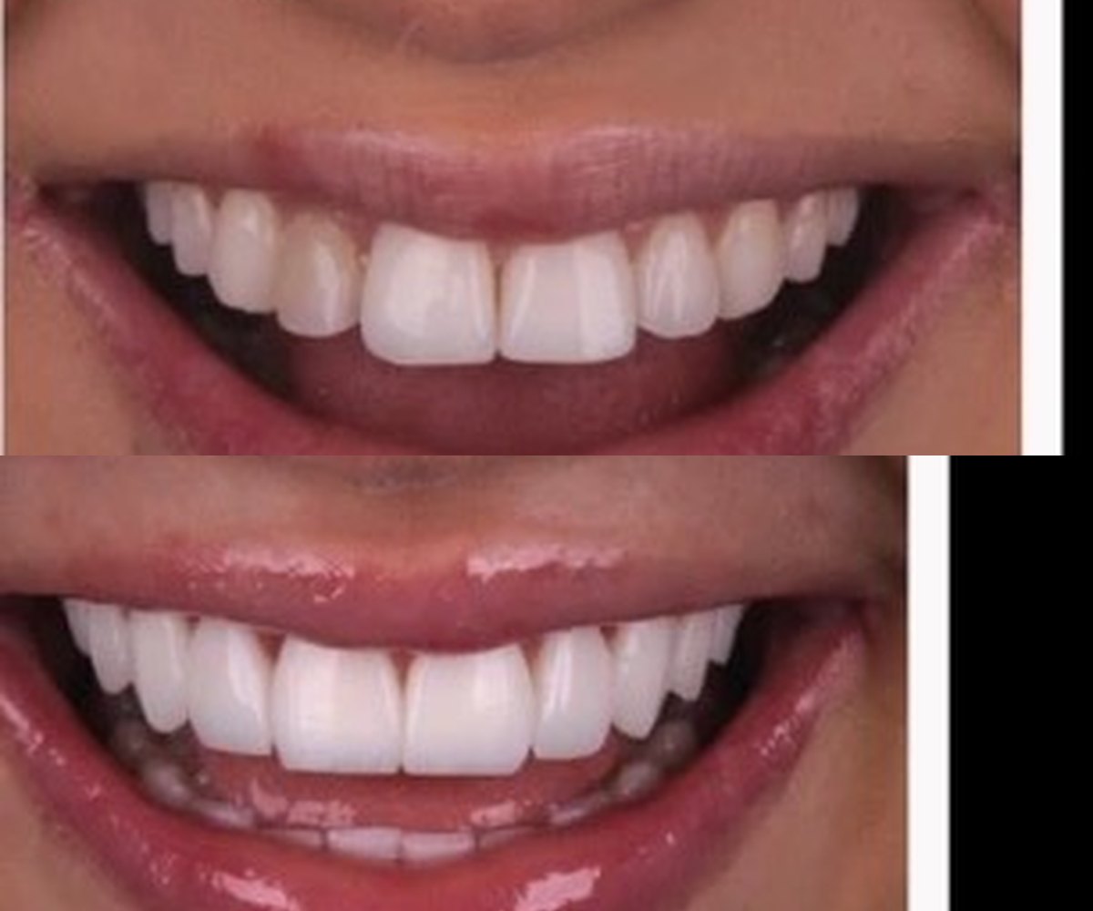 Diseño de sonrisa