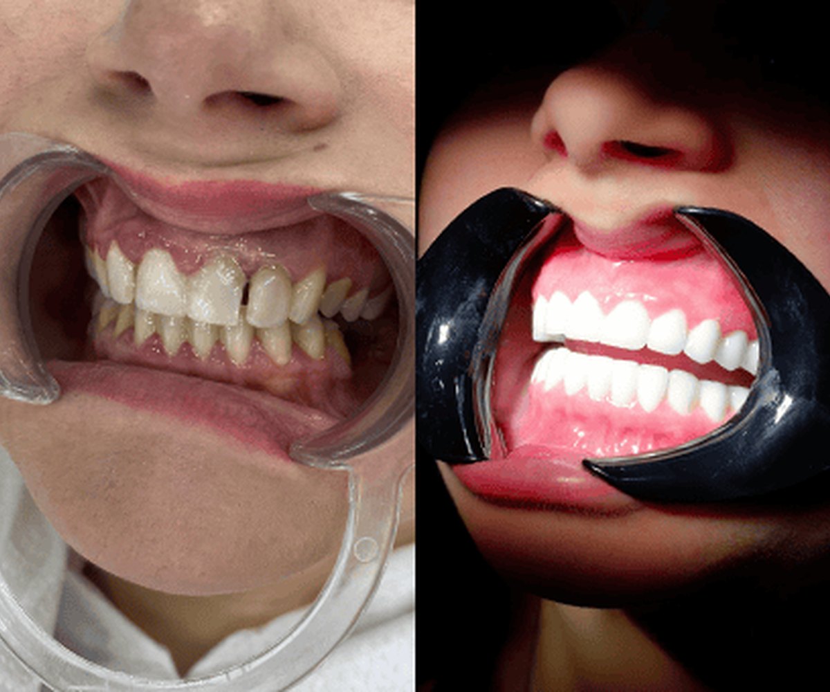 Diseño de sonrisa