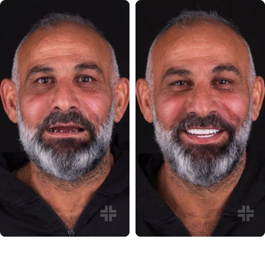 Dental result, before and after