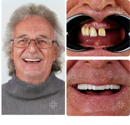 Dental result, before and after