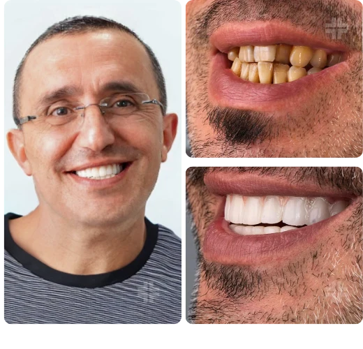 Dental result, before and after