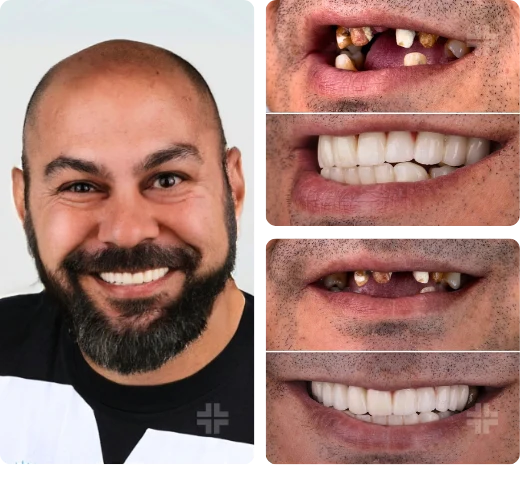 Dental result, before and after