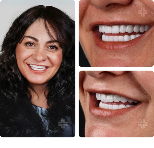 Dental result, before and after
