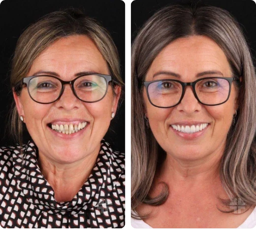 Dental result, before and after