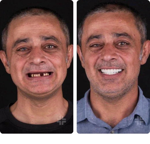 Dental result, before and after