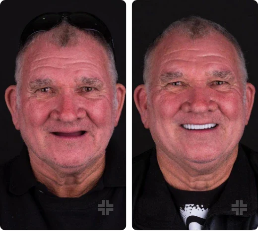 Dental result, before and after