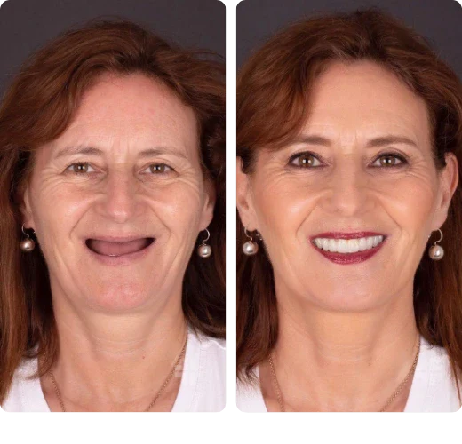 Dental result, before and after