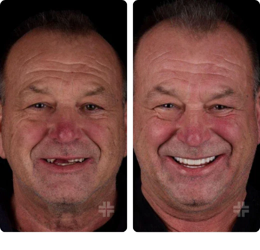 Dental result, before and after