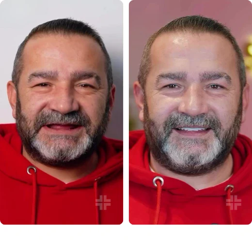 Dental result, before and after