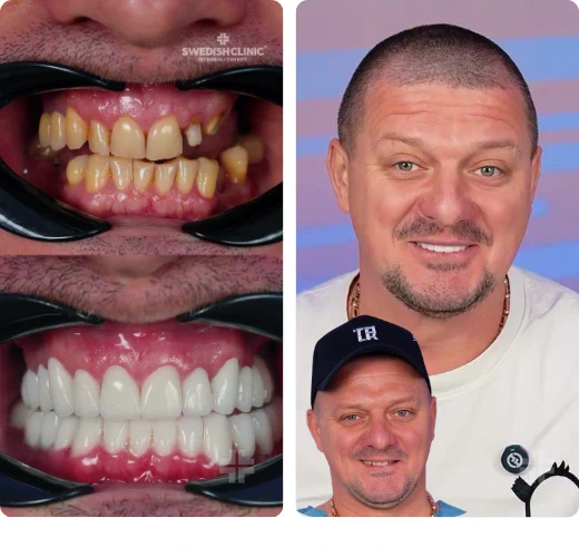 Dental result, before and after