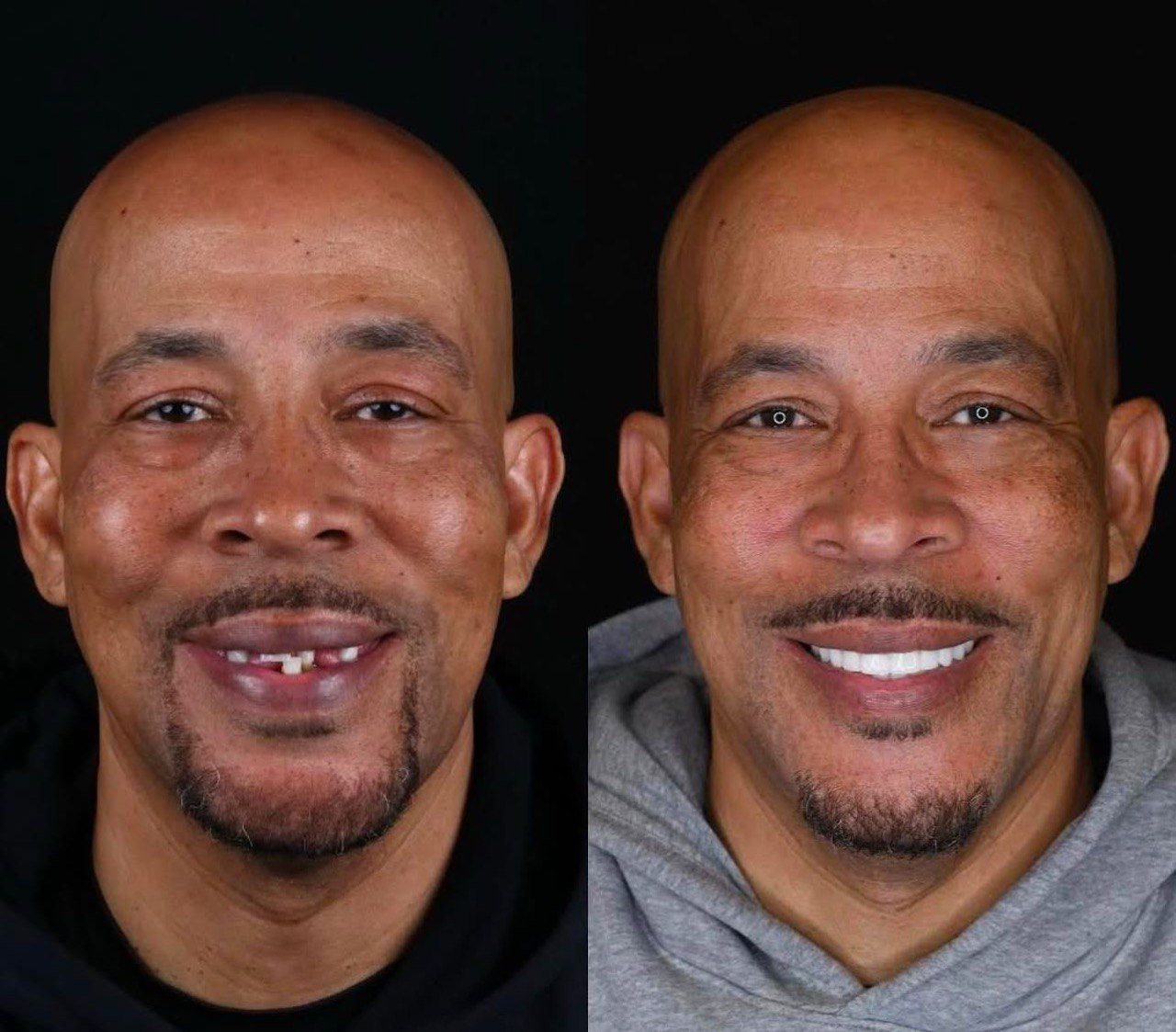 Before and after, one patient