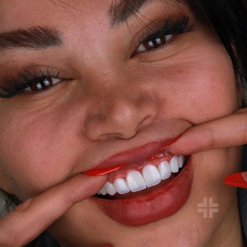 Finished smile