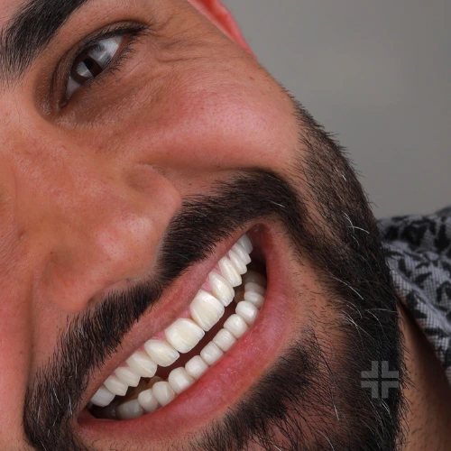 Finished smile