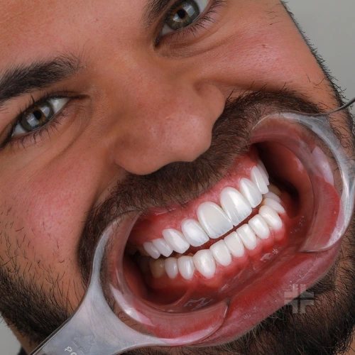 Finished smile