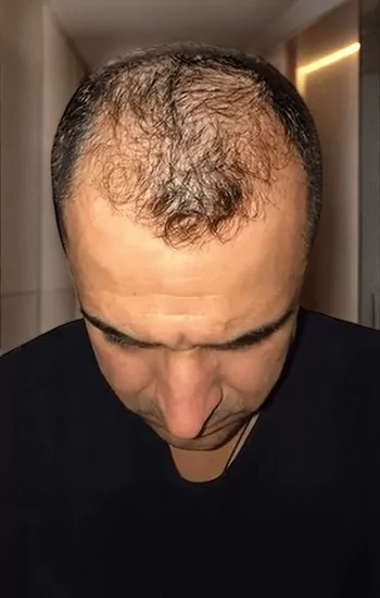Before and after