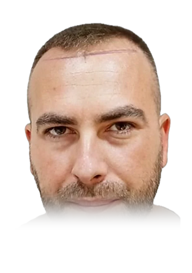 Marcus H. — hair transplant, before