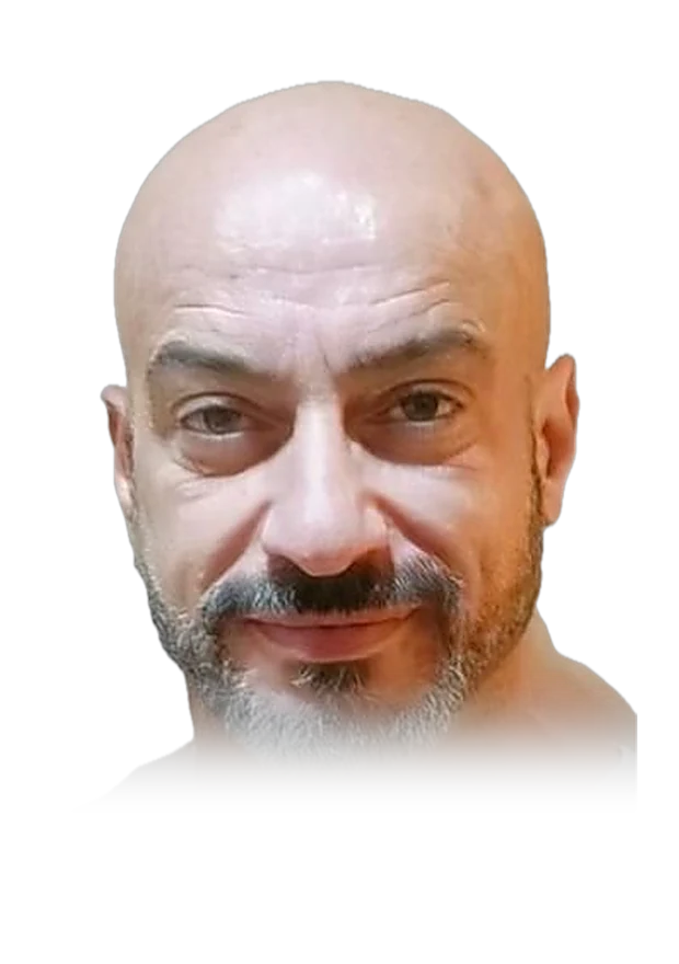 Peter S. — hair transplant, before