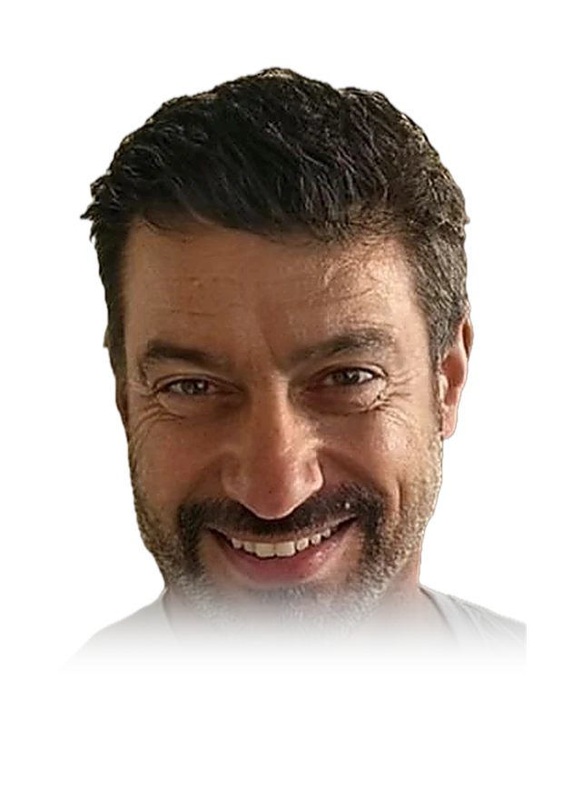 Peter S. — hair transplant, after