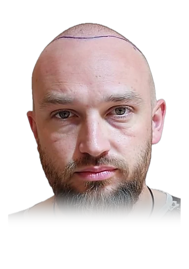 Liam O'C. — hair transplant, before