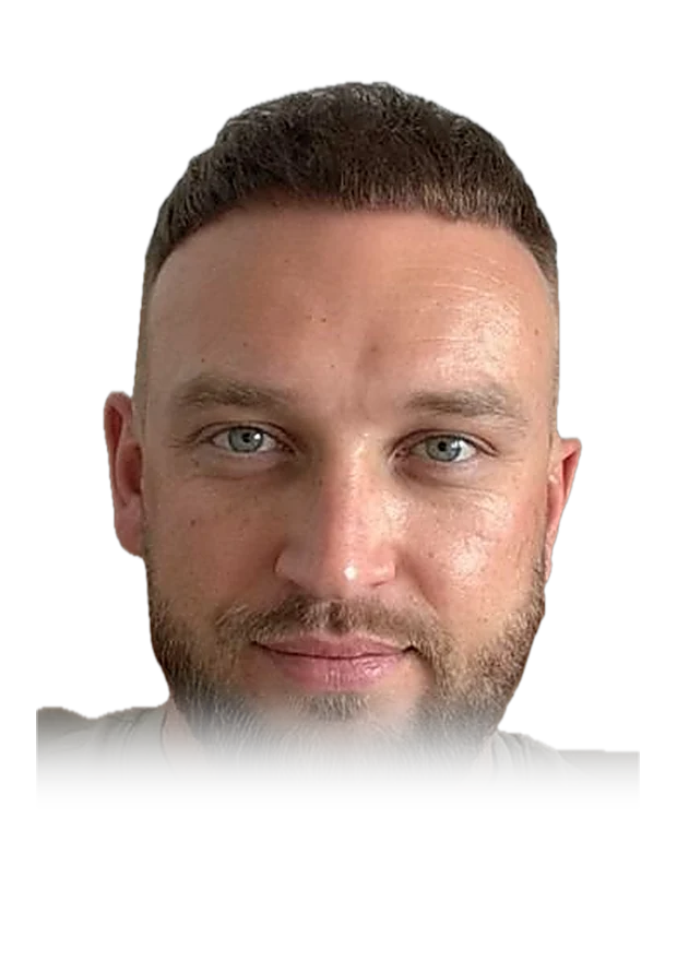 Liam O'C. — hair transplant, after