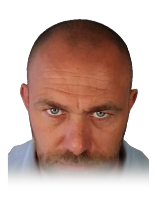Erik L. — hair transplant, before