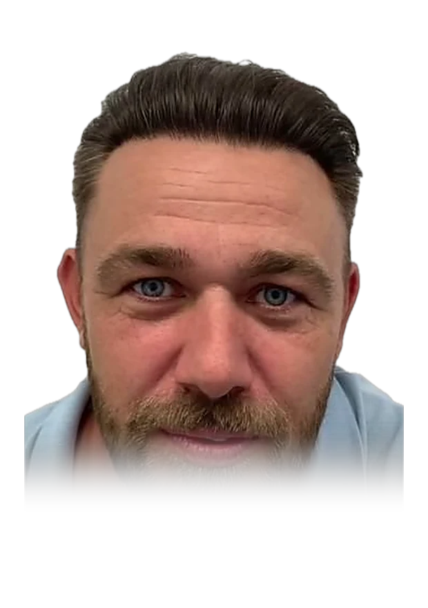 Erik L. — hair transplant, after