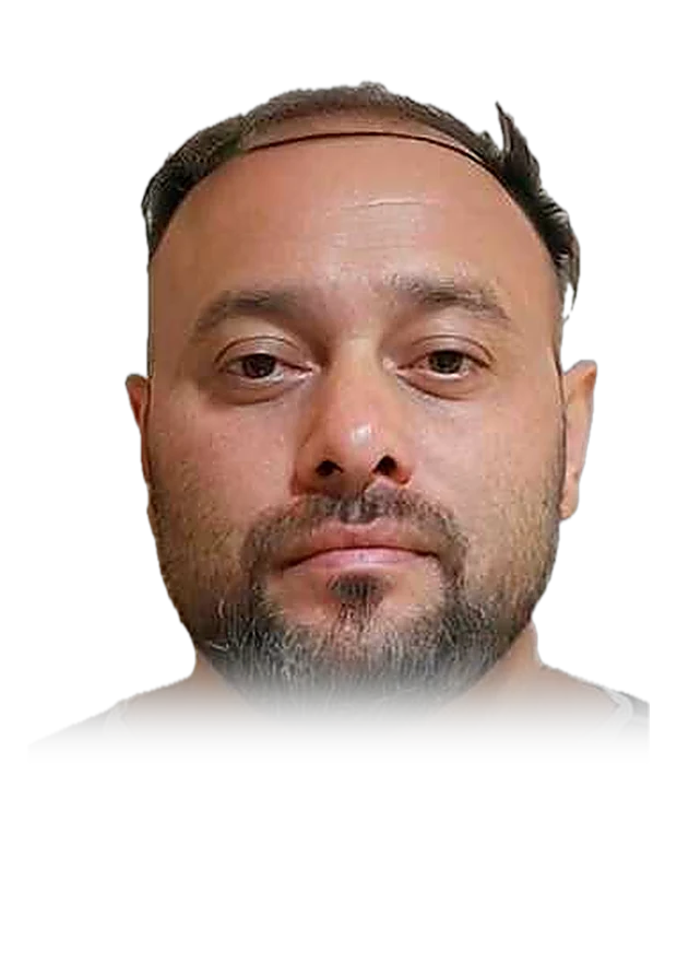 Antoine D. — hair transplant, before