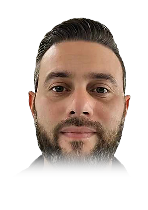 Antoine D. — hair transplant, after