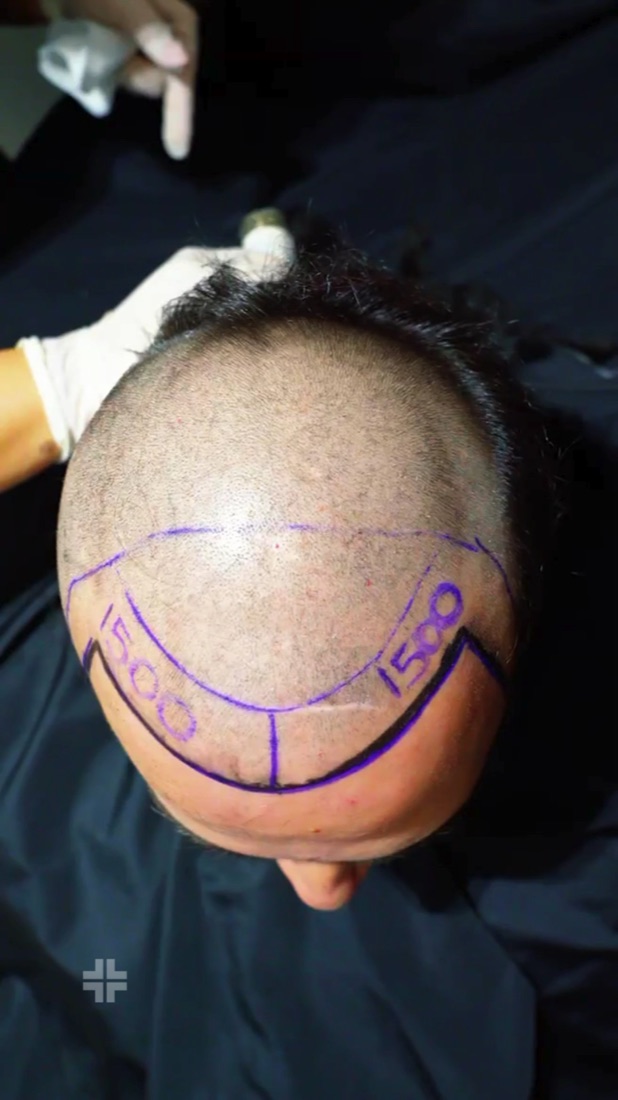 1,500 per side, written on the scalp