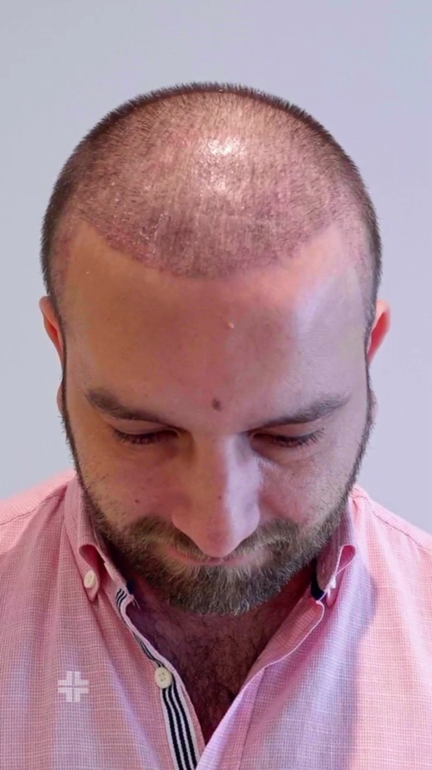 Single-follicle grafts, trimmed under magnification