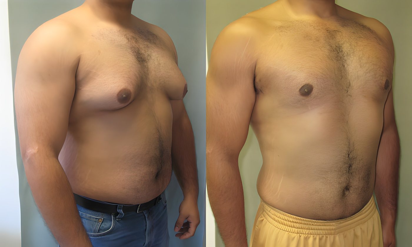 Gynecomastia, before and after