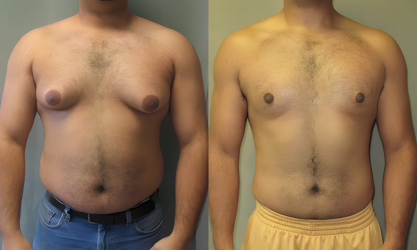 Before and after, one patient
