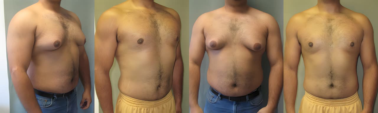 Gynecomastia, before and after