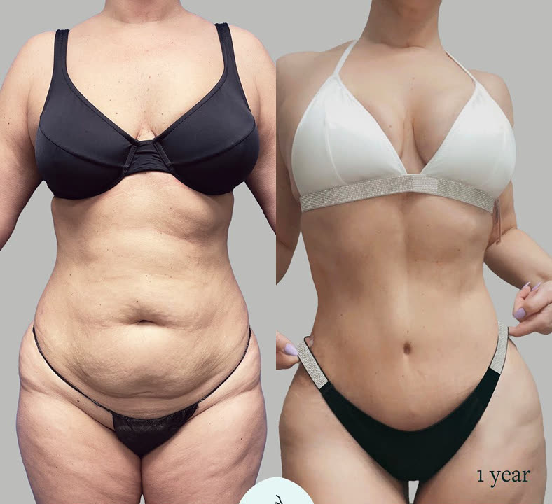 Tummy tuck, before and after