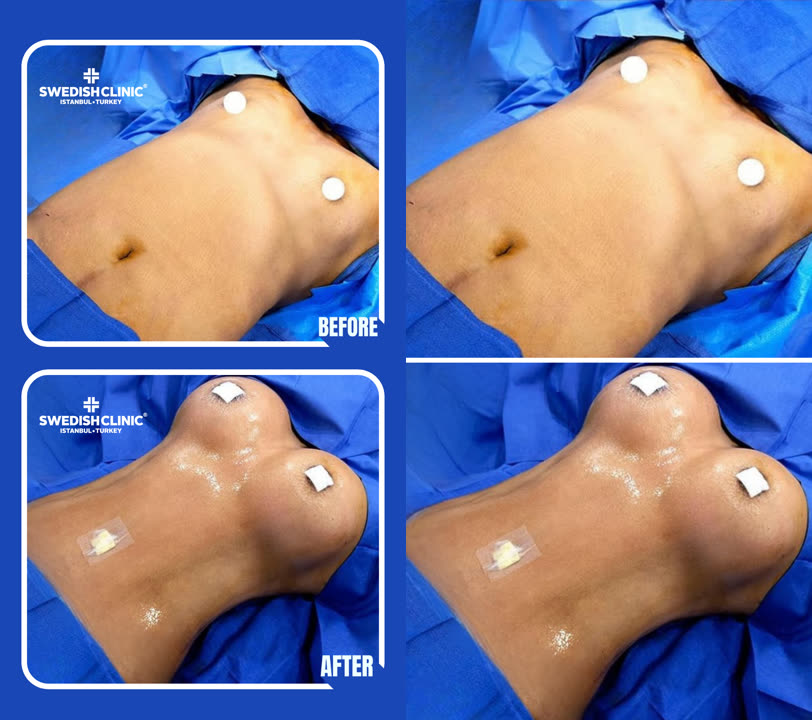 Breast surgery, before and after