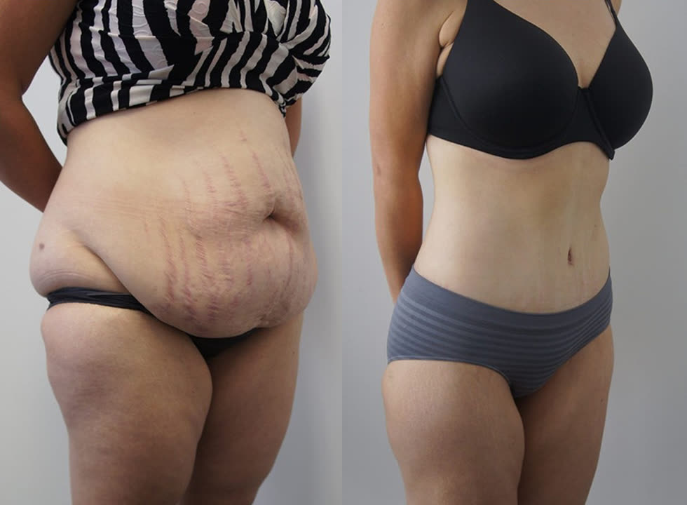 Tummy tuck, before and after