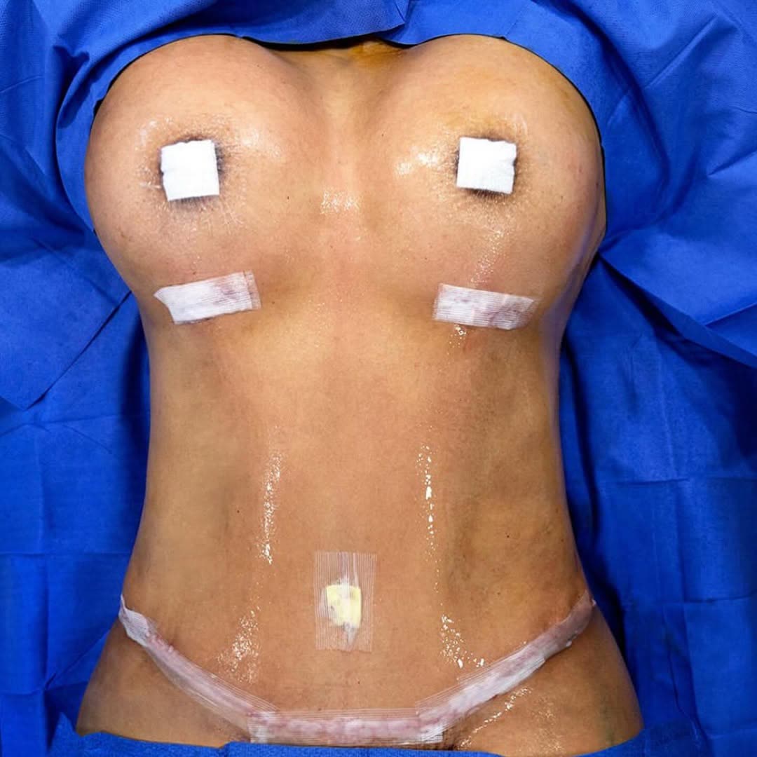 Breast surgery, before and after