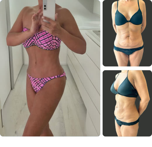Tummy tuck, before and after